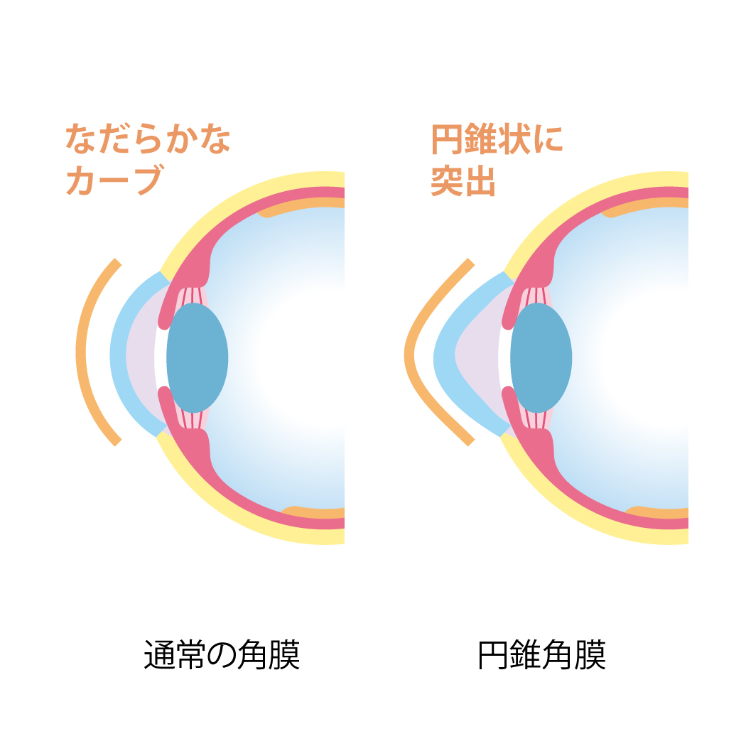 第29回「円錐角膜について」