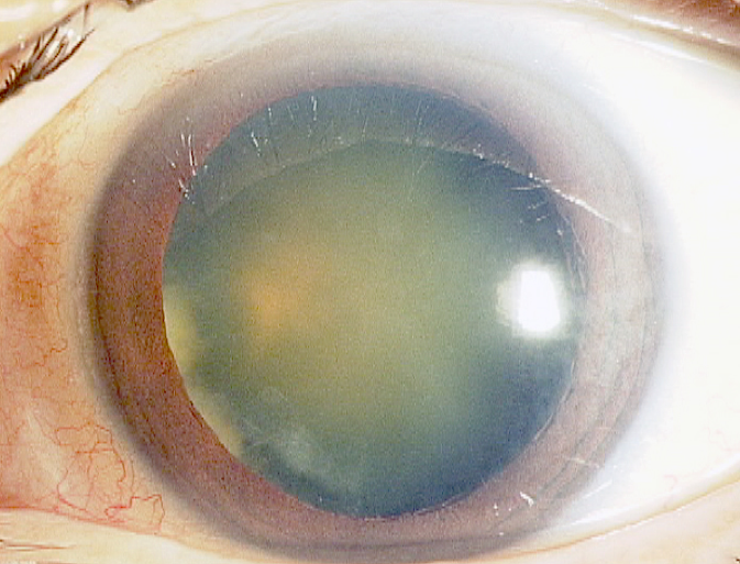 核白内障の眼